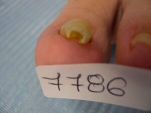 onicocriptosis-biomotion