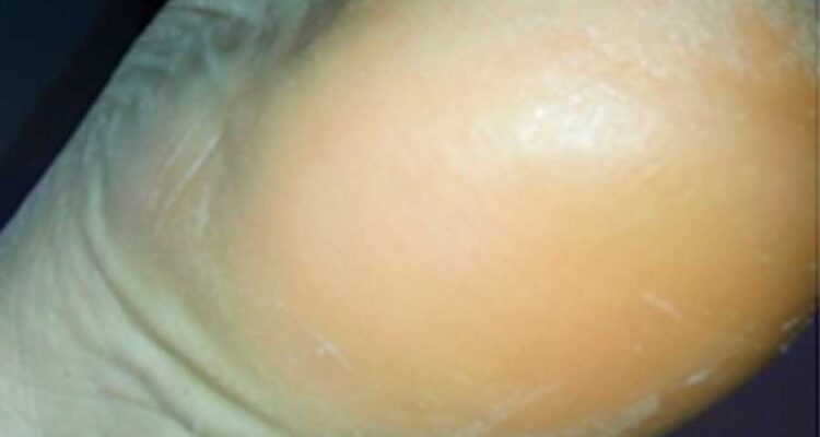 pie-diabetico-Biomotion