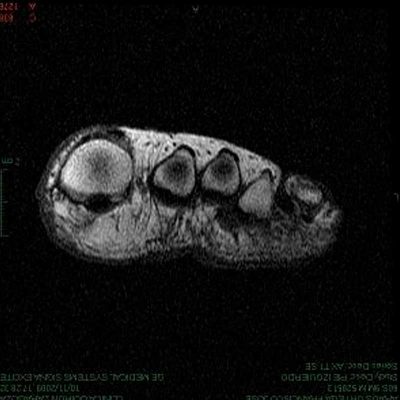 biomotion-metatarsalgia-2